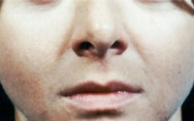 Before Image: Lip Enhancement Gallery - front