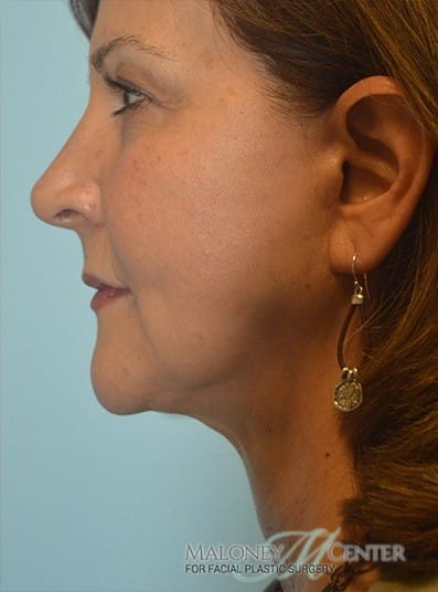 After Image: Neck Lift - left-side