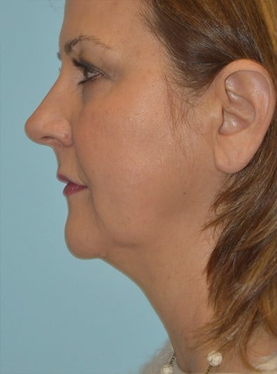 Before Image: Neck Lift - left-side