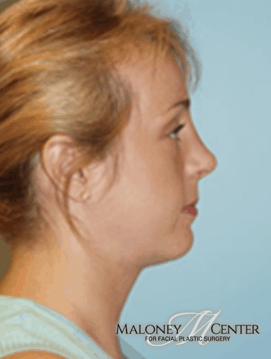 After Image: Neck Lift - right-side