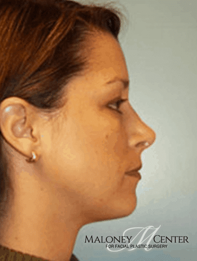 After Image: Neck Lift - right-side