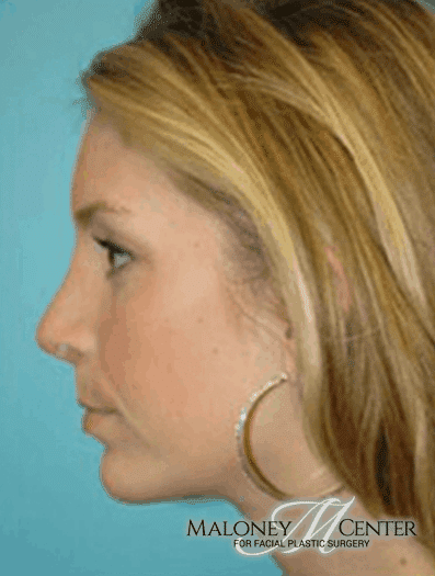 After Image: Neck Lift - left-side
