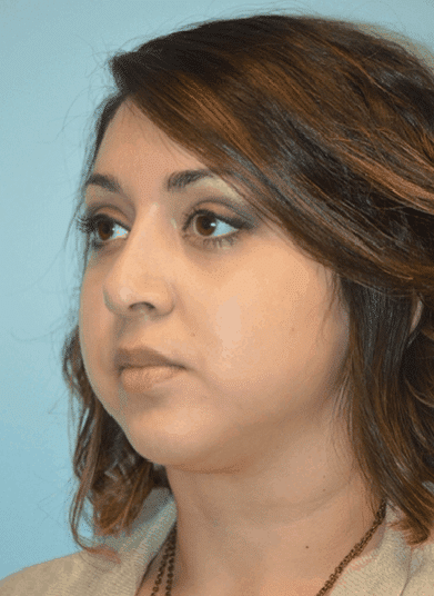 Before Image: Neck Lift - left-front-oblique