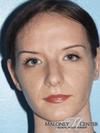 After Image: Otoplasty - front