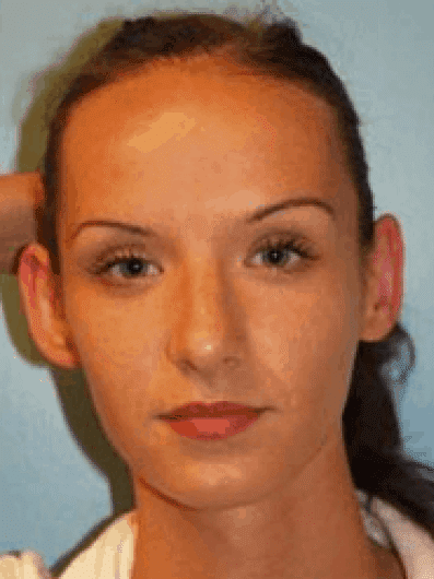 Before Image: Otoplasty - front