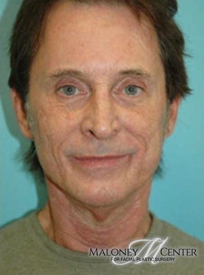 After Image: Male Cosmetic Surgery - front