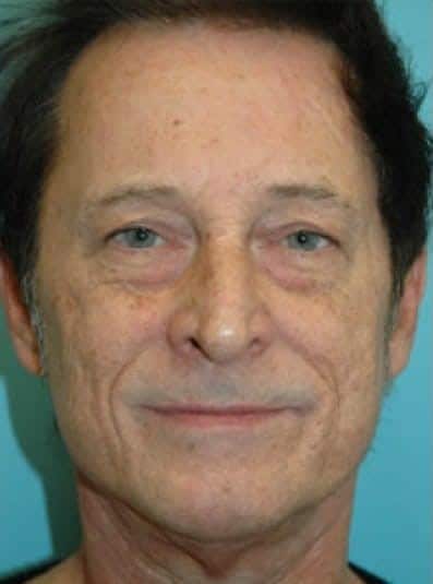 Before Image: Male Cosmetic Surgery - front