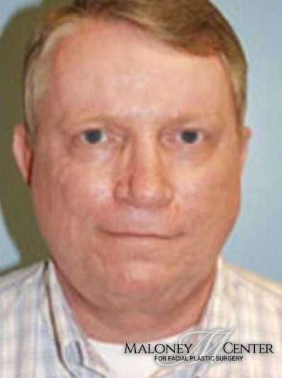 After Image: Male Cosmetic Surgery - front