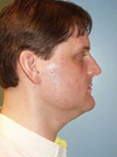 Before Image: Male Cosmetic Surgery - right-side