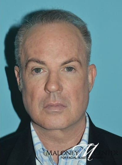 After Image: Male Cosmetic Surgery - front