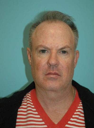 Before Image: Male Cosmetic Surgery - front