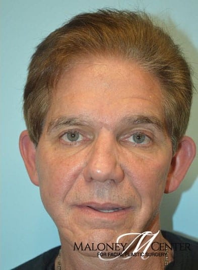 After Image: Male Cosmetic Surgery - front