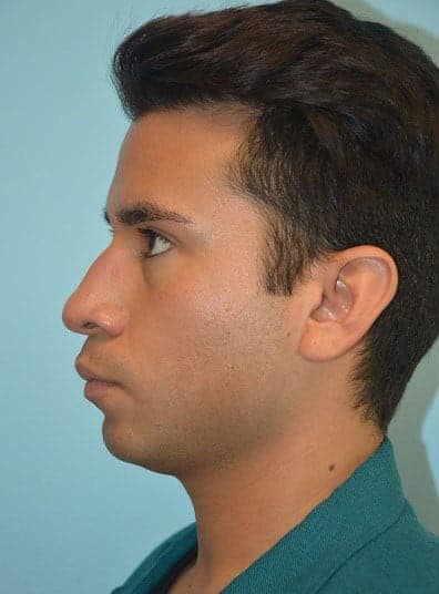 Before Image: Male Cosmetic Surgery - left-side