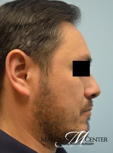 After Image: Male Cosmetic Surgery - right-side