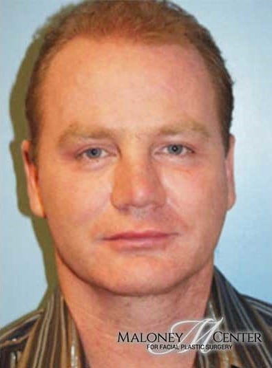 After Image: Male Cosmetic Surgery - front