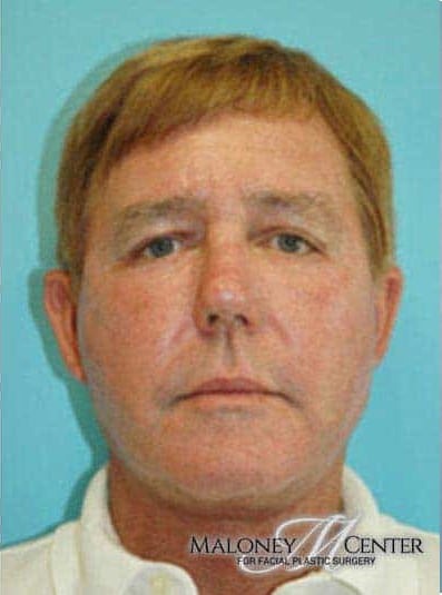 After Image: Male Cosmetic Surgery - front