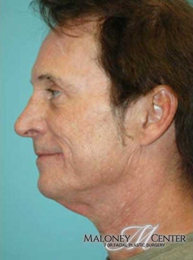After Image: Male Cosmetic Surgery - left-side
