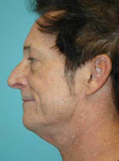 Before Image: Male Cosmetic Surgery - left-side
