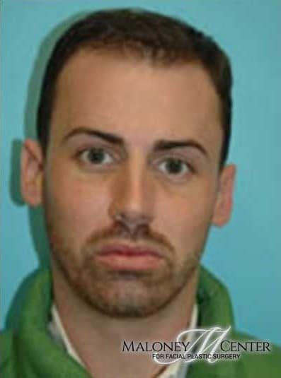 After Image: Male Cosmetic Surgery - front