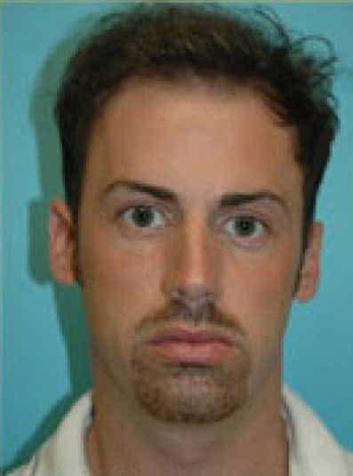 Before Image: Male Cosmetic Surgery - front