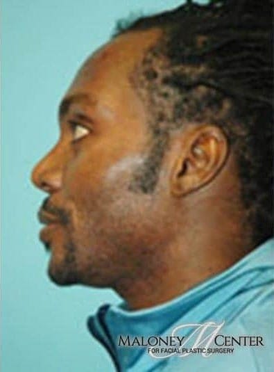 After Image: Male Cosmetic Surgery - left-side