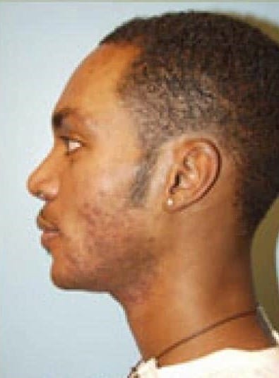 Before Image: Male Cosmetic Surgery - left-side