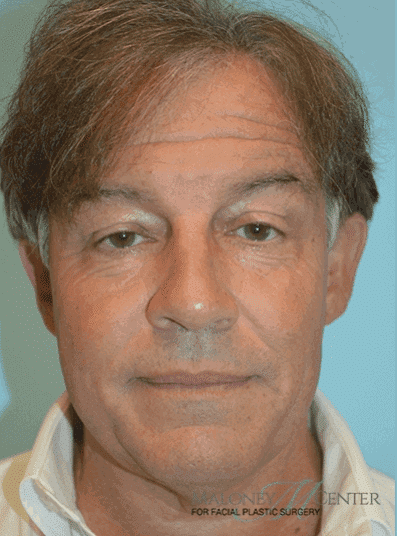 After Image: Male Cosmetic Surgery - front
