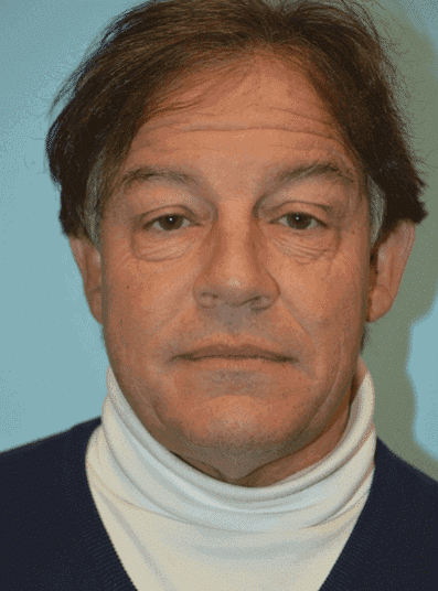 Before Image: Male Cosmetic Surgery - front