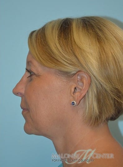 After Image: Rhinoplasty - left-side
