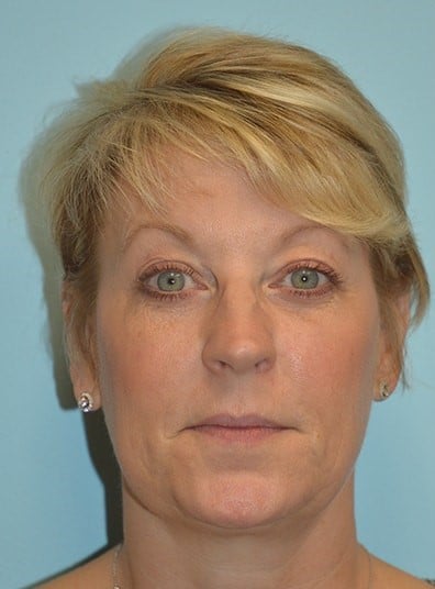 Before Image: Rhinoplasty - front