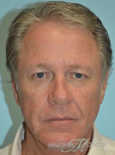 After Image: Rhinoplasty - front