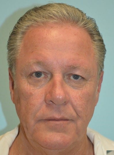 Before Image: Rhinoplasty - front