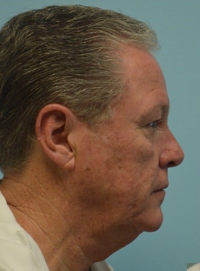 Before Image: Rhinoplasty - right-side