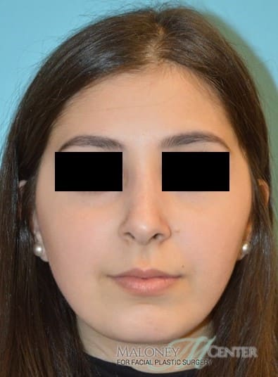After Image: Rhinoplasty - front
