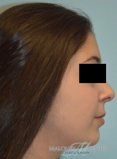 After Image: Rhinoplasty - right-side