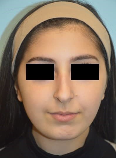 Before Image: Rhinoplasty - front