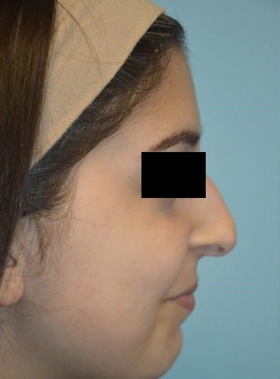 Before Image: Rhinoplasty - right-side