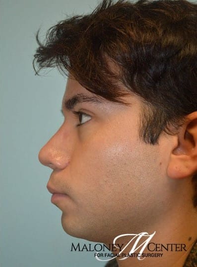 After Image: Rhinoplasty - left-side