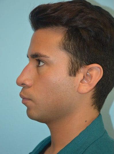 Before Image: Rhinoplasty - left-side