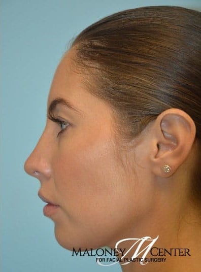After Image: Rhinoplasty - left-side