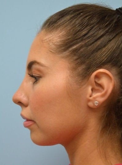 Before Image: Rhinoplasty - left-side