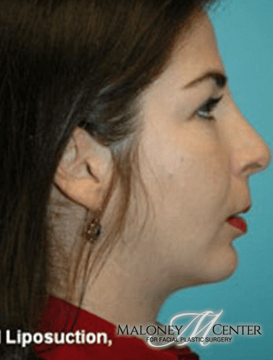After Image: Rhinoplasty - right-side