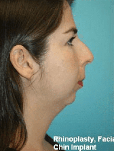 Before Image: Rhinoplasty - right-side