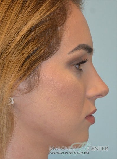 After Image: Rhinoplasty - right-side