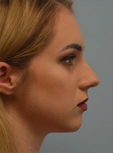 Before Image: Rhinoplasty - right-side