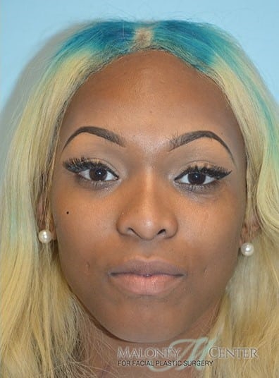 After Image: Rhinoplasty - front