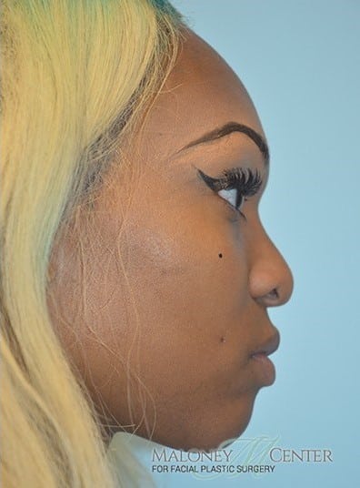 After Image: Rhinoplasty - right-side