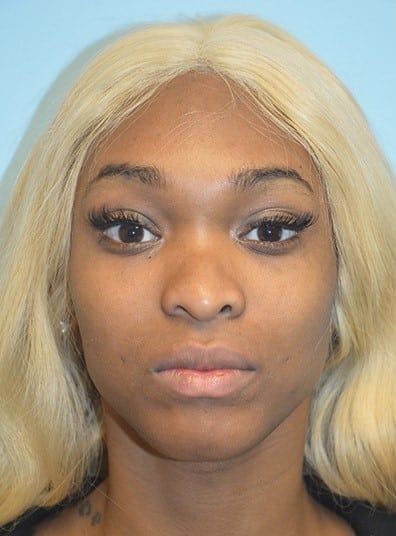 Before Image: Rhinoplasty - front