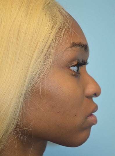 Before Image: Rhinoplasty - right-side