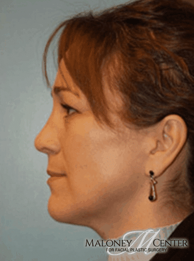 After Image: Rhinoplasty - left-side